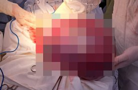 Тульские врачи удалили пациентке опухоль яичника размером с арбуз