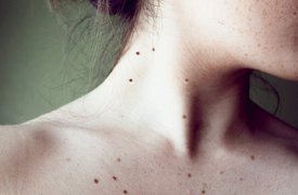 Туляки смогут бесплатно обследоваться на рак кожи
